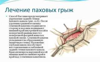 Пупочная и паховая грыжа — причины, симптомы и лечение
