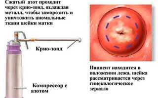 Лечение эрозии шейки матки