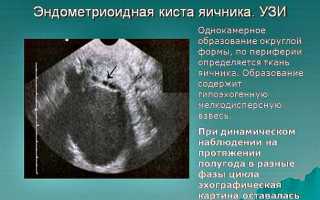 Можно ли забеременеть с кистой яичника?