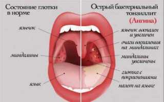 Как лечить лакунарную ангину