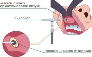Киста левой верхнечелюстной пазухи срочно лечить