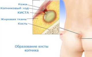 Копчиковая киста, признаки и методы лечения