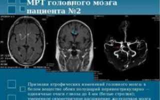 Глиоз головного мозга: симптомы, причины и лечение