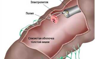 Симптомы полипов в кишечнике