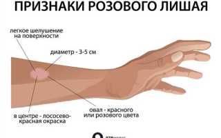 Как лечить лишай у детей