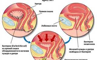 Признаки и лечение цистита у женщин