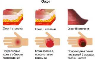 Как лечить ожог 3 степени