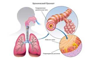 Можно ли после бронхита ехать на море