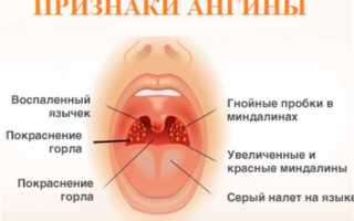 Симптомы гнойной ангины