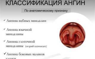 Как лечить катаральную ангину