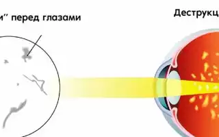 Как лечить деструкции стекловидного тела