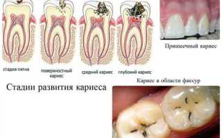 Как избавиться от зубной стружки