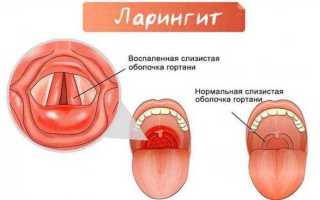 Лечение ларингита: эффективные методы и рекомендации