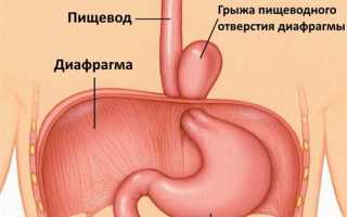 Как лечить грыжу желудка