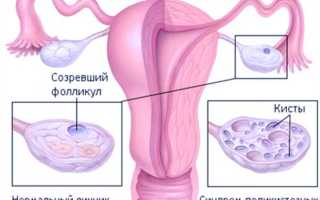 Как лечить поликистоз яичников