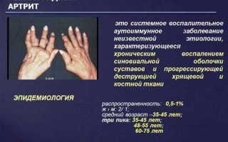 Симптомы артрита