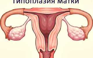 Что такое гипоплазия матки