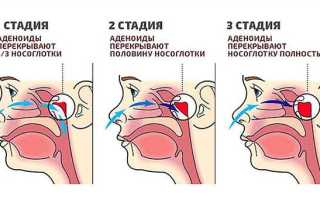 Как лечить аденоиды у ребёнка