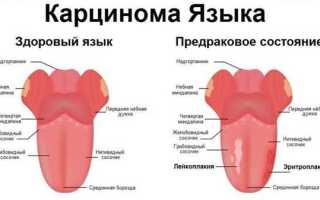 Кандидоз слизистой оболочки полости рта