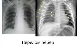 Как лечить трещину ребра