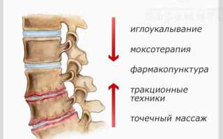 Как лечить остеохондроз поясничного отдела