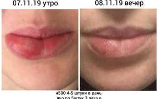 Способы лечения разбитой губы