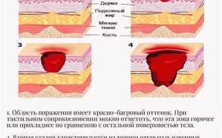 Как лечить пролежни в домашних условиях