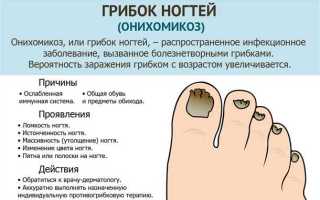 Как лечить грибок на ногтях ног