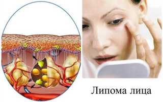 Как вылечить жировики на лице