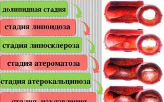 Когда развивается атеросклероз