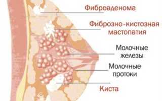 Симптомы мастопатии