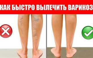 Лечение варикоза в домашних условиях