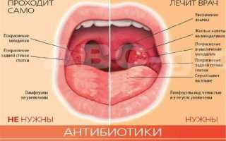 Как лечить ангину в домашних условиях