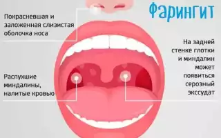 Как лечить фарингит у взрослых и детей