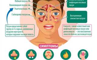 Синусит: симптомы у взрослых — враг, который нужно знать в лицо
